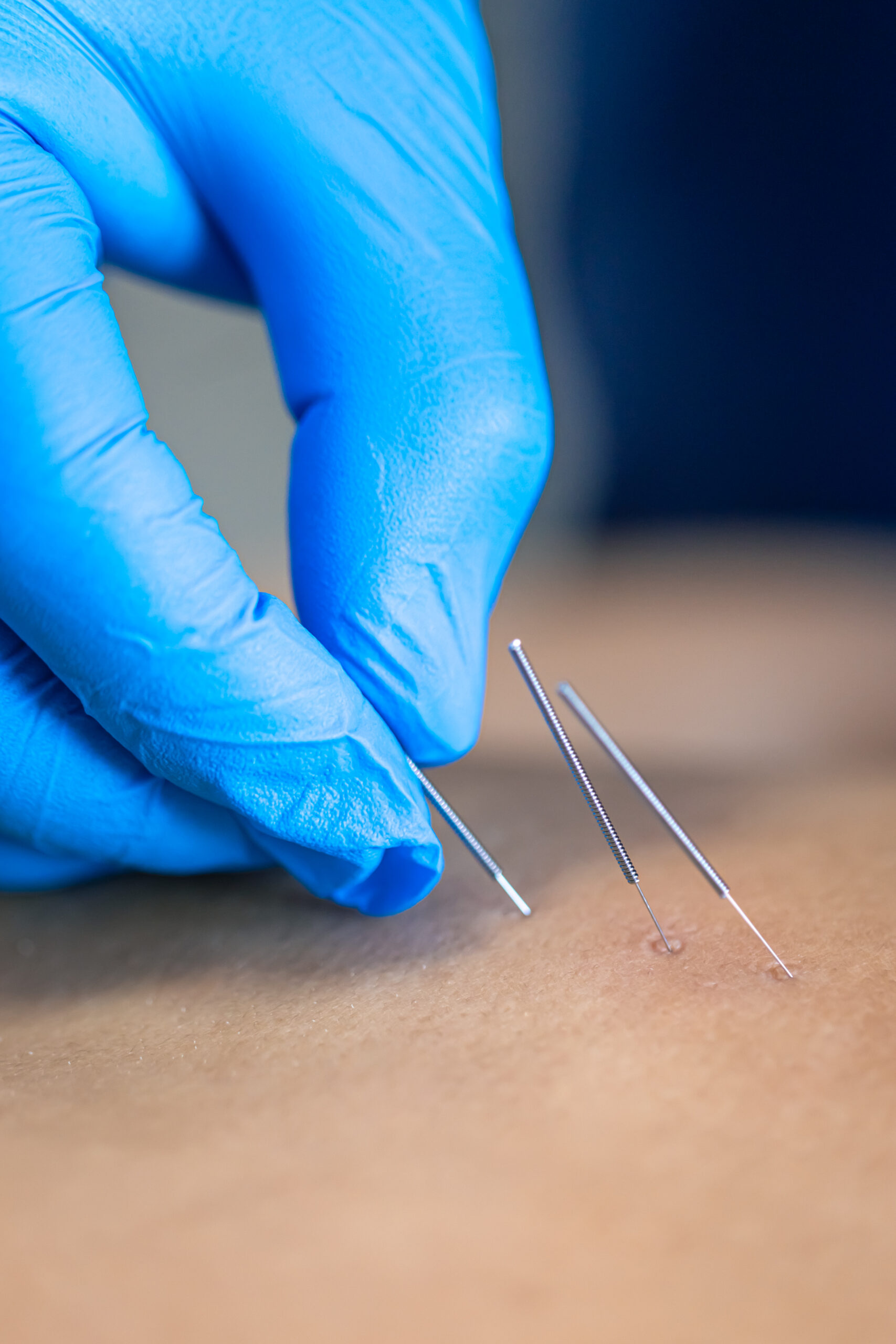 Close up of a needle and hands of physiotherapist doing a dry needling in a physiotherapy center.